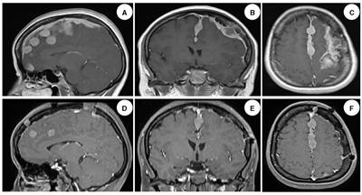 Multiple ossified intracranial and spinal meningiomas: a rare case report and literature review